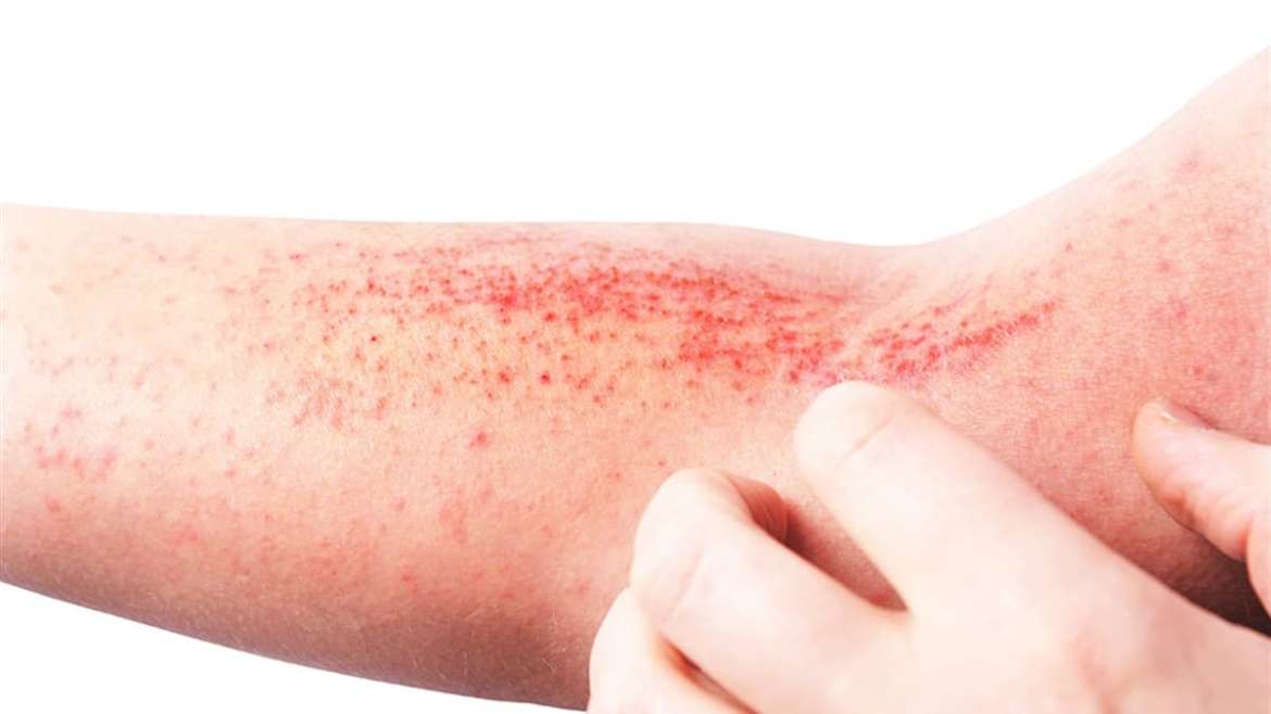 Egzema (Dermatit)